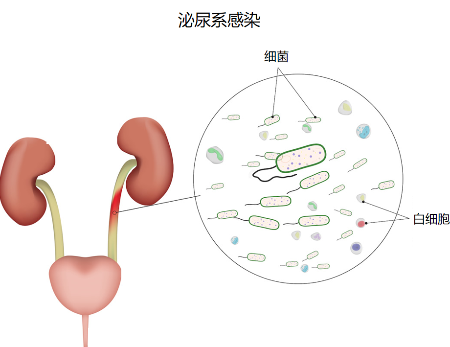 三伏天尿路結石的“高發季”，有哪些常見誤區