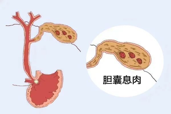 體檢出膽囊息肉，需要擔心嗎？