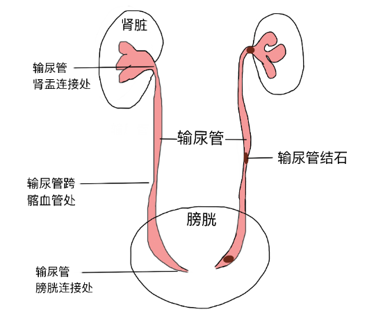 結石引發劇烈腎絞痛，該怎么辦？