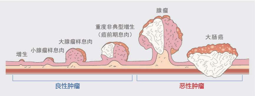 什么樣的腸息肉容易癌變？有一種要特別當心！