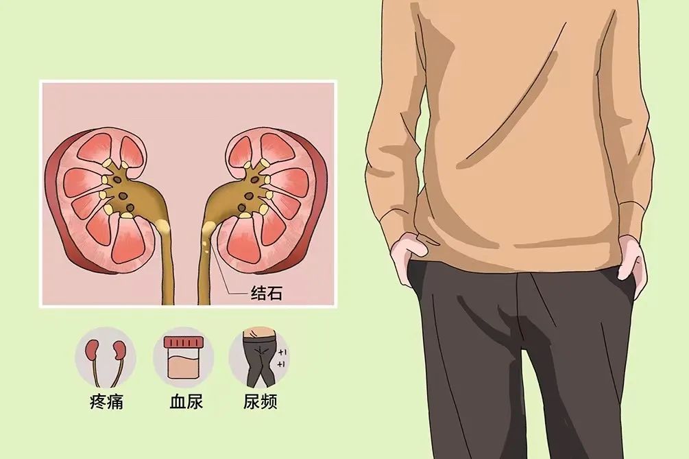 為什么很多人得腎結石？有2個習慣不要碰，腎會感激你