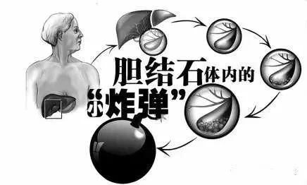 膽囊里的小結石要緊嗎？長大后再處理行不行？